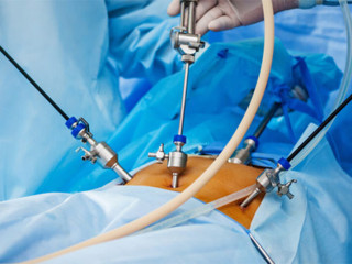 Advanced Myomectomy Surgery in Thane by Dr. Sujata Rathod