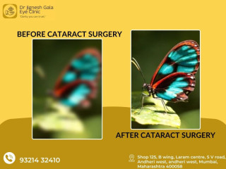 Cataract Surgeon in Andheri